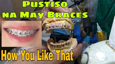 May Pustiso Gustong Magpabraces .